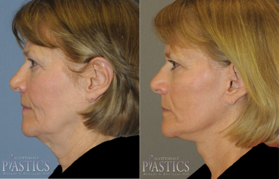 Facelift before and after photo