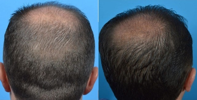 Hair Transplant before and after photo
