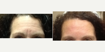 Juvederm before and after photo