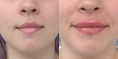 Lip Fillers before and after photo