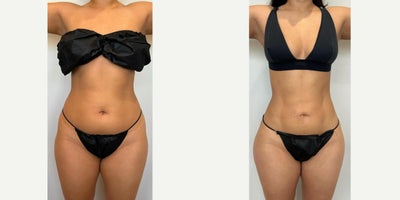 AirSculpt before and after photo