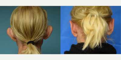 Ear Surgery before and after photo