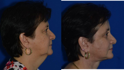 Facelift before and after photo