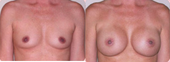 Breast Implants before and after photo