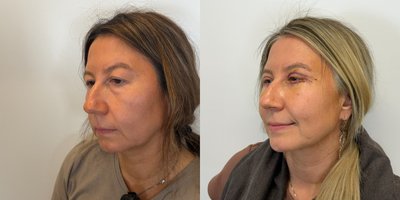 Eyelid Surgery before and after photo