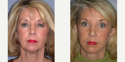 Facelift before and after photo