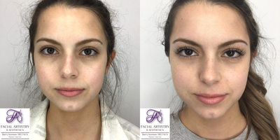 Radiesse before and after photo