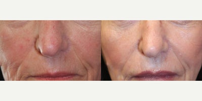 Botox before and after photo