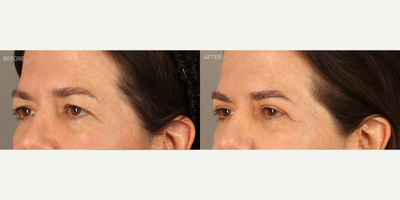 CO2 Laser before and after photo