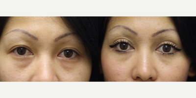 Double Eyelid Surgery before and after photo