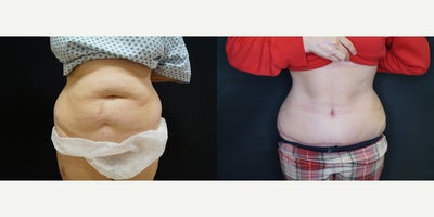 Drainless Tummy Tuck before and after photo