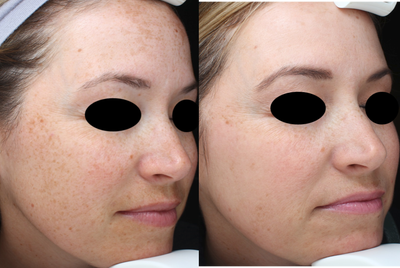 IPL before and after photo