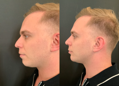Nonsurgical Nose Job before and after photo