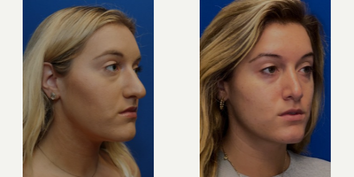 Rhinoplasty before and after photo