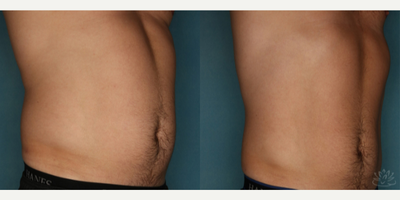 SculpSure before and after photo