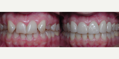 Smile Makeover before and after photo