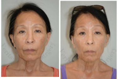 Ultherapy before and after photo