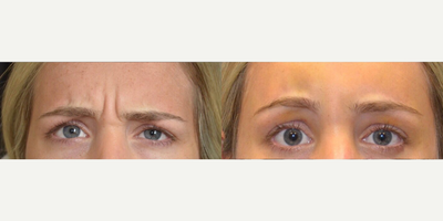 Brow Lift before and after photo