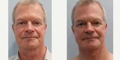 Facelift before and after photo