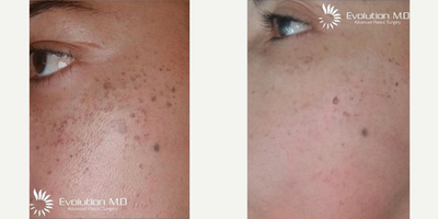 IPL before and after photo