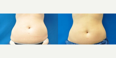 Liposonix before and after photo