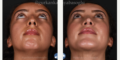Rhinoplasty before and after photo
