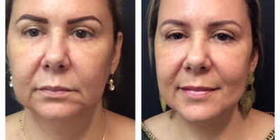 Ultherapy before and after photo