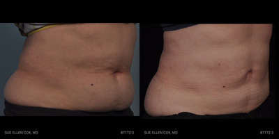 CoolSculpting before and after photo