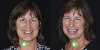 Dental Crown before and after photo