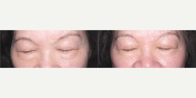 Eyelid Surgery before and after photo