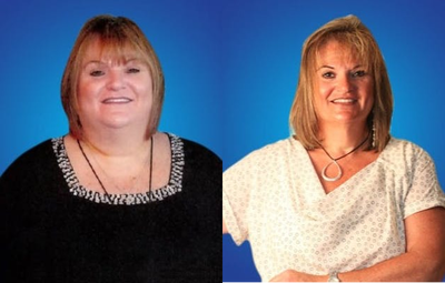 Gastric Bypass before and after photo