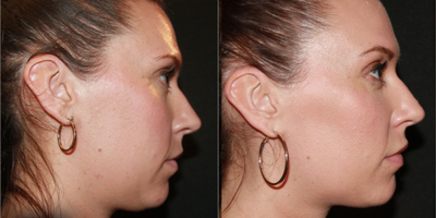 Kybella before and after photo