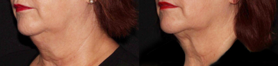 Kybella before and after photo