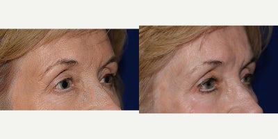 Chemical Peel before and after photo