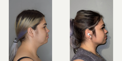 Chin Liposuction before and after photo