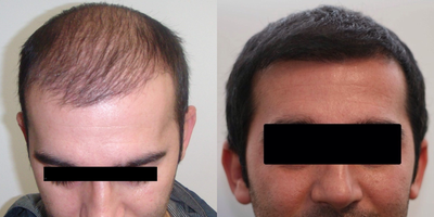 Hair Transplant before and after photo
