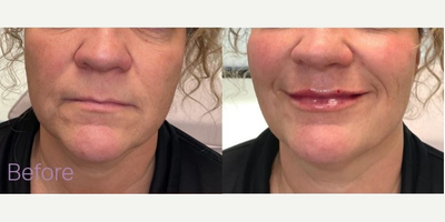 Lip Fillers before and after photo