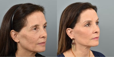 CO2 Laser before and after photo