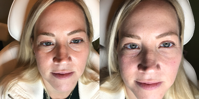 Dermal Fillers before and after photo