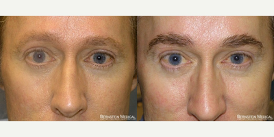 Eyebrow Transplant before and after photo