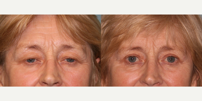 Eyelid Surgery before and after photo