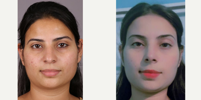 Rhinoplasty before and after photo