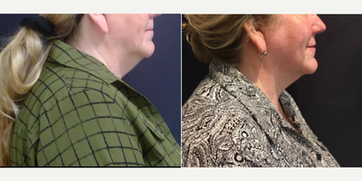 SculpSure before and after photo