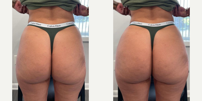 Thread Lift before and after photo