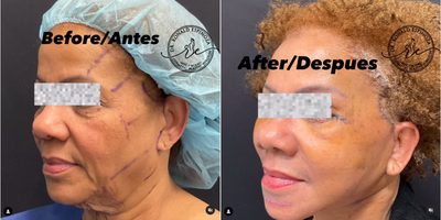 Eyelid Surgery before and after photo