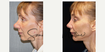 Revision Rhinoplasty before and after photo
