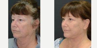 SMAS Facelift before and after photo