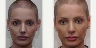 Rhinoplasty before and after photo