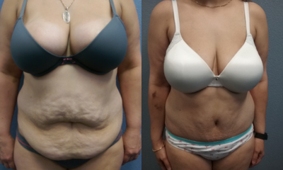 Tummy Tuck before and after photo