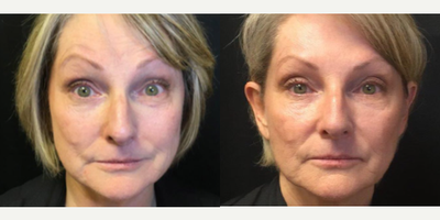 Botox before and after photo